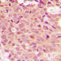 HDAC5 Antibody - Immunohistochemical analysis of Histone Deacetylase 5 (pS498) staining in human breast cancer formalin fixed paraffin embedded tissue section. The section was pre-treated using heat mediated antigen retrieval with sodium citrate buffer (pH 6.0). The section was then incubated with the antibody at room temperature and detected using an HRP conjugated compact polymer system. DAB was used as the chromogen. The section was then counterstained with hematoxylin and mounted with DPX.