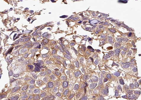 HDAC5 Antibody - 1:100 staining human breast carcinoma tissue by IHC-P. The tissue was formaldehyde fixed and a heat mediated antigen retrieval step in citrate buffer was performed. The tissue was then blocked and incubated with the antibody for 1.5 hours at 22°C. An HRP conjugated goat anti-rabbit antibody was used as the secondary.