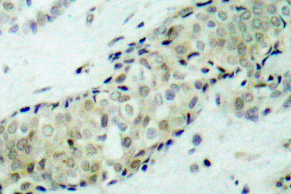 HDAC5 Antibody - IHC of HDAC5 (P492) pAb in paraffin-embedded human breast carcinoma tissue.