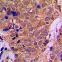 HDAC6 Antibody - Immunohistochemical analysis of Histone Deacetylase 6 staining in human breast cancer formalin fixed paraffin embedded tissue section. The section was pre-treated using heat mediated antigen retrieval with sodium citrate buffer (pH 6.0). The section was then incubated with the antibody at room temperature and detected using an HRP conjugated compact polymer system. DAB was used as the chromogen. The section was then counterstained with hematoxylin and mounted with DPX.