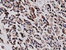 HDAC6 Antibody - IHC of paraffin-embedded Adenocarcinoma of Human colon tissue using anti-HDAC6 mouse monoclonal antibody. (Heat-induced epitope retrieval by 10mM citric buffer, pH6.0, 100C for 10min).
