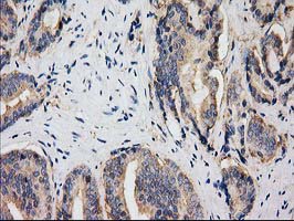 HDAC6 Antibody - IHC of paraffin-embedded Carcinoma of Human prostate tissue using anti-HDAC6 mouse monoclonal antibody. (Heat-induced epitope retrieval by 10mM citric buffer, pH6.0, 100C for 10min).