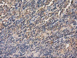 HDAC6 Antibody - IHC of paraffin-embedded Human lymphoma tissue using anti-HDAC6 mouse monoclonal antibody. (Heat-induced epitope retrieval by 10mM citric buffer, pH6.0, 100C for 10min).