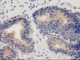 HDAC6 Antibody - IHC of paraffin-embedded Adenocarcinoma of Human endometrium tissue using anti-HDAC6 mouse monoclonal antibody.