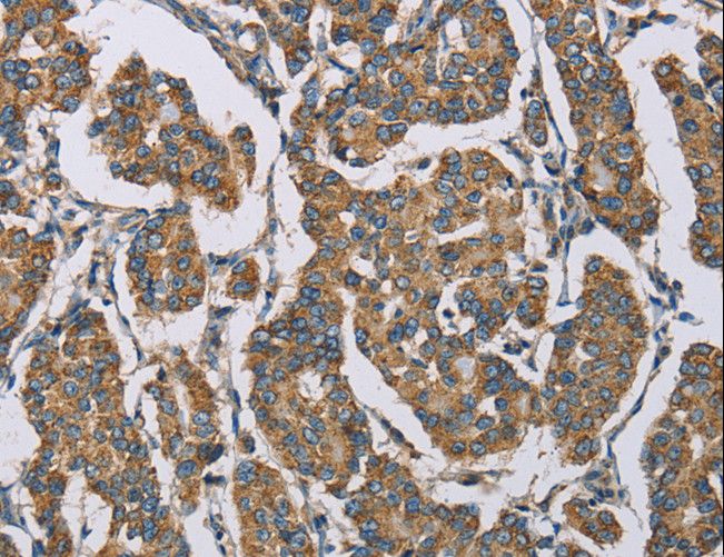 HDAC6 Antibody - Immunohistochemistry of paraffin-embedded Human cervical cancer using HDAC6 Polyclonal Antibody at dilution of 1:50.