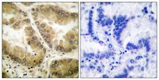 HDAC7 Antibody - Immunohistochemistry analysis of paraffin-embedded human lung carcinoma tissue, using HDAC7 Antibody. The picture on the right is blocked with the synthesized peptide.