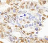 HDAC7 Antibody - Detection of Human HDAC7 by Immunohistochemistry. Sample: FFPE section of human ovarian carcinoma. Antibody: Affinity purified rabbit anti-HDAC7 used at a dilution of 1:100.