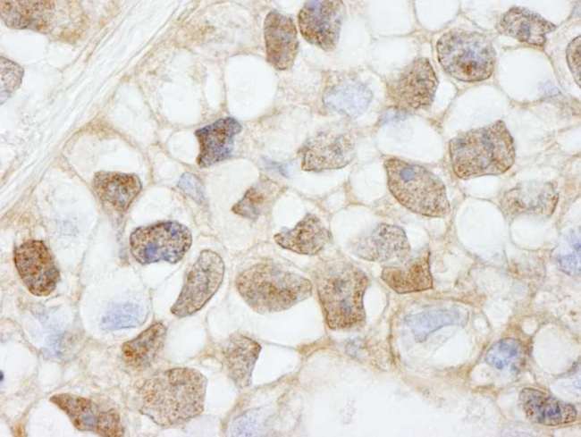 HDAC7 Antibody - Detection of Human HDAC7 by Immunohistochemistry. Sample: FFPE section of human breast carcinoma. Antibody: Affinity purified rabbit anti-HDAC7 used at a dilution of 1:100.