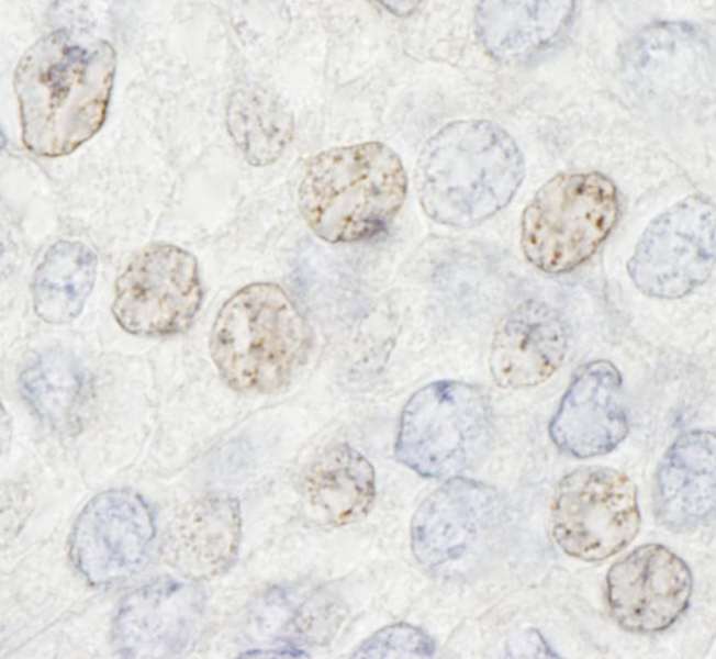 HDAC7 Antibody - Detection of Human HDAC7 by Immunohistochemistry. Sample: FFPE section of human prostate carcinoma. Antibody: Affinity purified rabbit anti-HDAC7 used at a dilution of 1:500.
