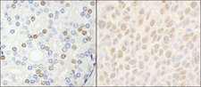 HDAC7 Antibody - Detection of Human and Mouse HDAC7 by Immunohistochemistry. Sample: FFPE section of human prostate carcinoma (left) and mouse colon carcinoma (right). Antibody: Affinity purified rabbit anti-HDAC7 used at a dilution of 1:5000 (0.2and 1:1000 (1 Detection: DAB.