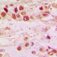 HDAC7 Antibody - Immunohistochemical analysis of Histone Deacetylase 7 staining in human lung cancer formalin fixed paraffin embedded tissue section. The section was pre-treated using heat mediated antigen retrieval with sodium citrate buffer (pH 6.0). The section was then incubated with the antibody at room temperature and detected using an HRP conjugated compact polymer system. DAB was used as the chromogen. The section was then counterstained with hematoxylin and mounted with DPX.