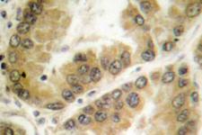 HDAC7 Antibody - IHC of HDAC7 (G932) pAb in paraffin-embedded human lung carcinoma tissue.