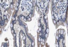 HDAC7 Antibody - 1:100 staining human colon carcinoma tissue by IHC-P. The tissue was formaldehyde fixed and a heat mediated antigen retrieval step in citrate buffer was performed. The tissue was then blocked and incubated with the antibody for 1.5 hours at 22°C. An HRP conjugated goat anti-rabbit antibody was used as the secondary.