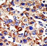 HDAC8 Antibody - Formalin-fixed and paraffin-embedded human cancer tissue reacted with the primary antibody, which was peroxidase-conjugated to the secondary antibody, followed by AEC staining. This data demonstrates the use of this antibody for immunohistochemistry; clinical relevance has not been evaluated. BC = breast carcinoma; HC = hepatocarcinoma.