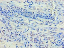 HDAC8 Antibody - Immunohistochemistry of paraffin-embedded human breast cancer using antibody at 1:100 dilution.  This image was taken for the unconjugated form of this product. Other forms have not been tested.