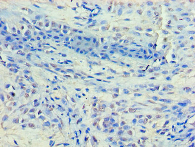 HDAC8 Antibody - Immunohistochemistry of paraffin-embedded human breast cancer using HDAC8 Antibody at dilution of 1:100
