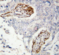 HDAC8 Antibody - HDAC8 antibody. IHC(P): Human Lung Cancer Tissue.