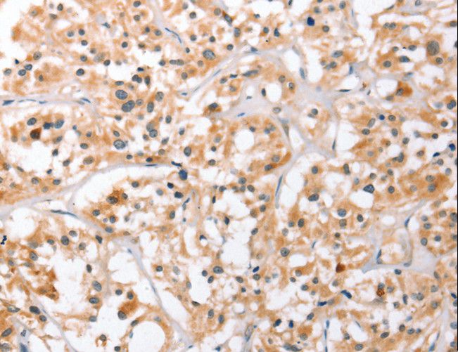 HDAC8 Antibody - Immunohistochemistry of paraffin-embedded Human thyroid cancer using HDAC8 Polyclonal Antibody at dilution of 1:40.