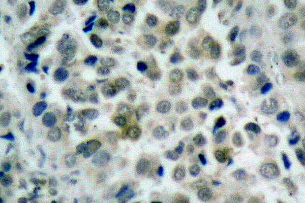 HDAC8 Antibody - IHC of HDAC8 (K33) pAb in paraffin-embedded human lung carcinoma tissue.