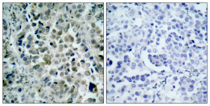 HDAC8 Antibody - Immunohistochemical analysis of paraffin- embedded lung carcinoma, using HDAC8 (Ab-39) Antibody. Left: Untreated; Right: Treated with synthesized phosphopeptide.