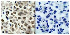 HDAC8 Antibody - Immunohistochemistry analysis of paraffin-embedded human lung carcinoma, using HDAC8 (Phospho-Ser39) Antibody. The picture on the right is blocked with the phospho peptide.