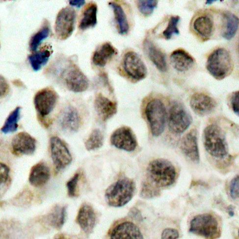 HDAC8 Antibody - Immunohistochemical analysis of paraffin-embedded human lung carcinoma tissue.
