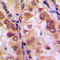 HDAC8 Antibody - Immunohistochemical analysis of Histone Deacetylase 8 (pS39) staining in human lung cancer formalin fixed paraffin embedded tissue section. The section was pre-treated using heat mediated antigen retrieval with sodium citrate buffer (pH 6.0). The section was then incubated with the antibody at room temperature and detected using an HRP conjugated compact polymer system. DAB was used as the chromogen. The section was then counterstained with hematoxylin and mounted with DPX.