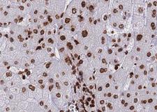 HDAC8 Antibody - 1:100 staining human liver carcinoma tissues by IHC-P. The tissue was formaldehyde fixed and a heat mediated antigen retrieval step in citrate buffer was performed. The tissue was then blocked and incubated with the antibody for 1.5 hours at 22°C. An HRP conjugated goat anti-rabbit antibody was used as the secondary.