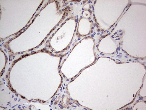 HDAC9 Antibody - Immunohistochemical staining of paraffin-embedded Human thyroid tissue within the normal limits using anti-HDAC9 mouse monoclonal antibody. (Heat-induced epitope retrieval by 1 mM EDTA in 10mM Tris, pH8.5, 120C for 3min,