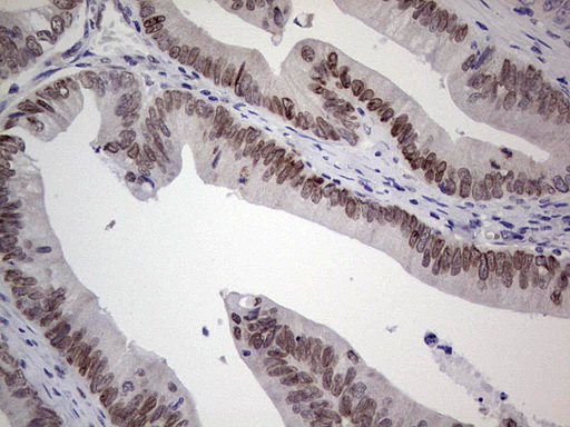 HDAC9 Antibody - IHC of paraffin-embedded Adenocarcinoma of Human colon tissue using anti-HDAC9 mouse monoclonal antibody. (Heat-induced epitope retrieval by 1 mM EDTA in 10mM Tris, pH8.5, 120°C for 3min).
