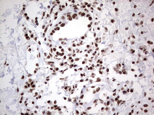 HDAC9 Antibody - Immunohistochemical staining of paraffin-embedded Carcinoma of Human lung tissue using anti-HDAC9 mouse monoclonal antibody. (Heat-induced epitope retrieval by 1 mM EDTA in 10mM Tris, pH8.5, 120C for 3min,