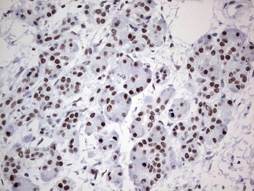 HDAC9 Antibody - Immunohistochemical staining of paraffin-embedded Carcinoma of Human pancreas tissue using anti-HDAC9 mouse monoclonal antibody. (Heat-induced epitope retrieval by 1 mM EDTA in 10mM Tris, pH8.5, 120C for 3min,