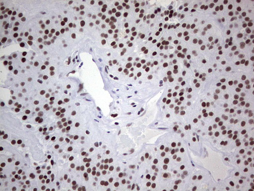 HDAC9 Antibody - Immunohistochemical staining of paraffin-embedded Carcinoma of Human thyroid tissue using anti-HDAC9 mouse monoclonal antibody. (Heat-induced epitope retrieval by 1 mM EDTA in 10mM Tris, pH8.5, 120C for 3min,