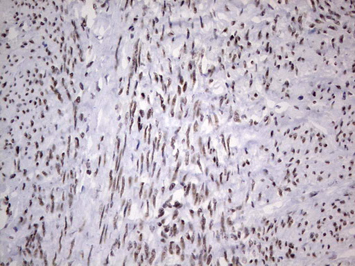 HDAC9 Antibody - Immunohistochemical staining of paraffin-embedded Adenocarcinoma of Human endometrium tissue using anti-HDAC9 mouse monoclonal antibody. (Heat-induced epitope retrieval by 1 mM EDTA in 10mM Tris, pH8.5, 120C for 3min,