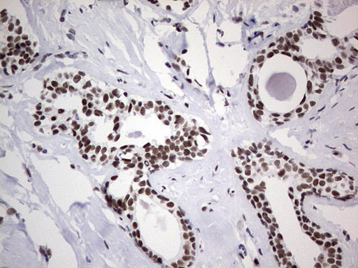 HDAC9 Antibody - Immunohistochemical staining of paraffin-embedded Adenocarcinoma of Human breast tissue using anti-HDAC9 mouse monoclonal antibody. (Heat-induced epitope retrieval by 1 mM EDTA in 10mM Tris, pH8.5, 120C for 3min,