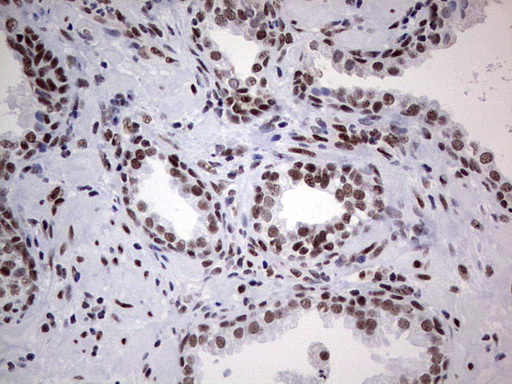 HDAC9 Antibody - Immunohistochemical staining of paraffin-embedded Carcinoma of Human prostate tissue using anti-HDAC9 mouse monoclonal antibody. (Heat-induced epitope retrieval by 1 mM EDTA in 10mM Tris, pH8.5, 120C for 3min,