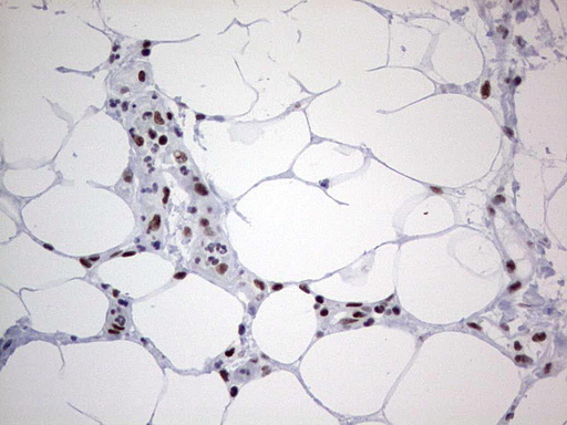 HDAC9 Antibody - Immunohistochemical staining of paraffin-embedded Carcinoma of Human bladder tissue using anti-HDAC9 mouse monoclonal antibody. (Heat-induced epitope retrieval by 1 mM EDTA in 10mM Tris, pH8.5, 120C for 3min,