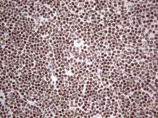 HDAC9 Antibody - Immunohistochemical staining of paraffin-embedded Human lymphoma tissue using anti-HDAC9 mouse monoclonal antibody. (Heat-induced epitope retrieval by 1 mM EDTA in 10mM Tris, pH8.5, 120C for 3min,