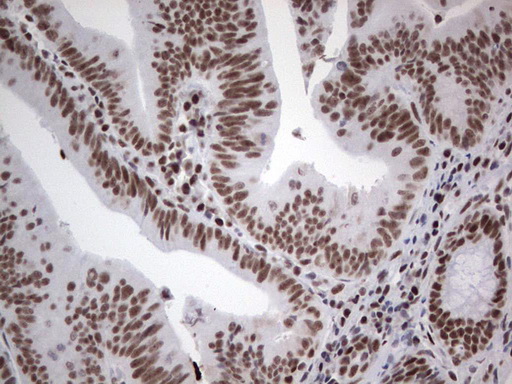 HDAC9 Antibody - Immunohistochemical staining of paraffin-embedded Adenocarcinoma of Human colon tissue using anti-HDAC9 mouse monoclonal antibody. (Heat-induced epitope retrieval by 1 mM EDTA in 10mM Tris, pH8.5, 120C for 3min,