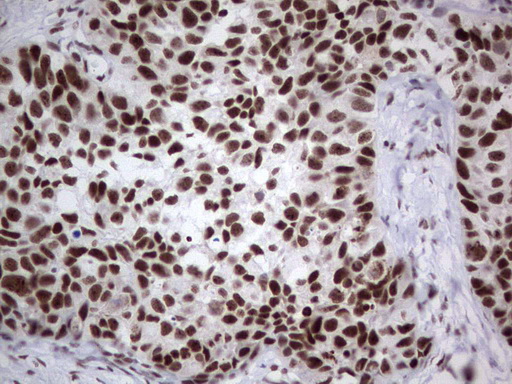 HDAC9 Antibody - Immunohistochemical staining of paraffin-embedded Carcinoma of Human kidney tissue using anti-HDAC9 mouse monoclonal antibody. (Heat-induced epitope retrieval by 1 mM EDTA in 10mM Tris, pH8.5, 120C for 3min,