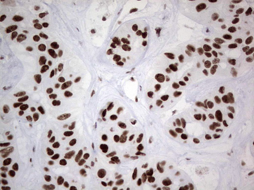HDAC9 Antibody - Immunohistochemical staining of paraffin-embedded Carcinoma of Human liver tissue using anti-HDAC9 mouse monoclonal antibody. (Heat-induced epitope retrieval by 1 mM EDTA in 10mM Tris, pH8.5, 120C for 3min,