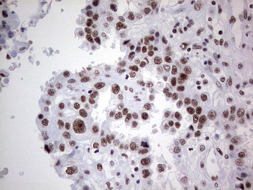 HDAC9 Antibody - IHC of paraffin-embedded Adenocarcinoma of Human ovary tissue using anti-HDAC9 mouse monoclonal antibody. (Heat-induced epitope retrieval by 1 mM EDTA in 10mM Tris, pH8.5, 120°C for 3min).