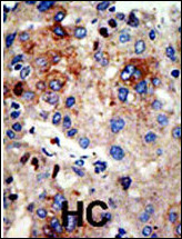 HDAC9 Antibody - Formalin-fixed and paraffin-embedded human cancer tissue reacted with the primary antibody, which was peroxidase-conjugated to the secondary antibody, followed by AEC staining. This data demonstrates the use of this antibody for immunohistochemistry; clinical relevance has not been evaluated. BC = breast carcinoma; HC = hepatocarcinoma.