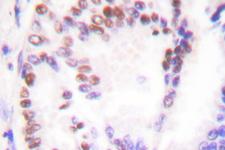 HDAC9 Antibody - IHC of HDAC9 (P1047) pAb in paraffin-embedded human lung carcinoma tissue.
