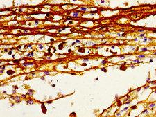 HDC / Histidine Decarboxylase Antibody - Immunohistochemistry image of paraffin-embedded human melanoma cancer at a dilution of 1:100