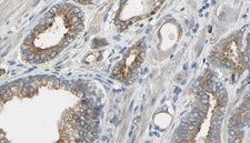 HDC / Histidine Decarboxylase Antibody - 1:100 staining human prostate tissue by IHC-P. The sample was formaldehyde fixed and a heat mediated antigen retrieval step in citrate buffer was performed. The sample was then blocked and incubated with the antibody for 1.5 hours at 22°C. An HRP conjugated goat anti-rabbit antibody was used as the secondary.