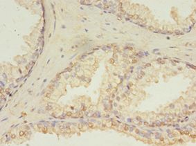 HDDC3 Antibody - Immunohistochemistry of paraffin-embedded human prostate cancer using antibody at 1:100 dilution.  This image was taken for the unconjugated form of this product. Other forms have not been tested.