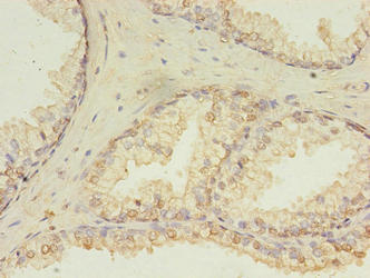 HDDC3 Antibody - Immunohistochemistry of paraffin-embedded human prostate cancer using HDDC3 Antibody at dilution of 1:100