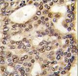 HDGF Antibody - Formalin-fixed and paraffin-embedded human hepatocarcinoma tissue reacted with HDGF antibody , which was peroxidase-conjugated to the secondary antibody, followed by DAB staining. This data demonstrates the use of this antibody for immunohistochemistry; clinical relevance has not been evaluated.