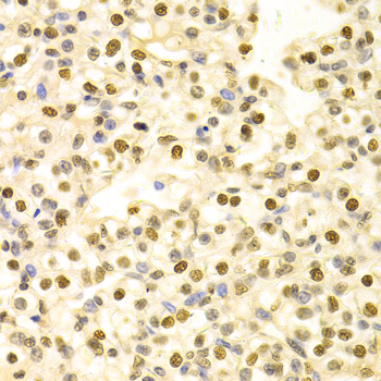 HDGF Antibody - Immunohistochemistry of paraffin-embedded human kidney cancer tissue.